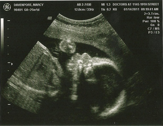 [baby 25 weeks 2[2].jpg]