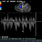 PW Doppler trace of CVC, Same Dog