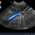 CVC 6 weeks post-ligation – Same Dog (no anomalous vessel)