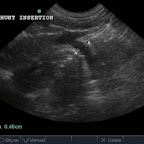 Extrahepatic Portosystemic Shunt in a 6mo Bichon cross: point of insertion into CVC
