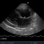 Biatrial Enlargement in a 10yo DSH with Restrictive Cardiomyopathy