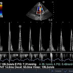 Pulsed Wave Doppler showing restrictive Mitral Inflow Pattern, Same Cat