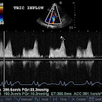 CW Doppler of tricuspid stenosis, same dog
