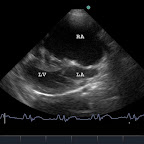 Right Atrial Enlargement in a 9mo Labrador with Tricuspid Dysplasia and Stenosis