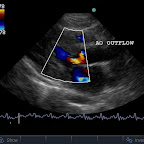 Turbulent Aortic Outflow and Mitral Regurgitation associated with SAM