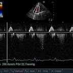 'Schitmar'-shaped dynamic Aortic Outflow Obstruction