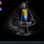 Colour flow of Mitral Stenosis (Left Apical View)