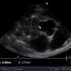 Aortic Root Mass in an Irish Wolfhound