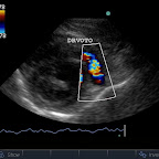 DRVOTO (Dynamic Right Ventricular Outflow Tract Obstruction)