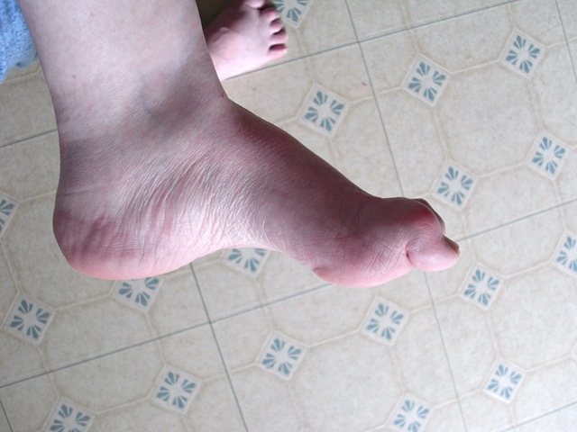 [left foot BEFORE[5].jpg]