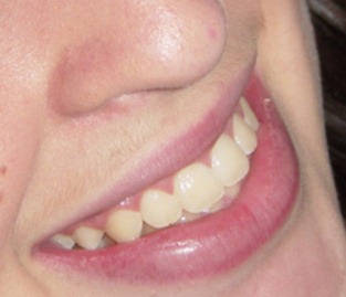 Dentes amarelados - foto modelo
