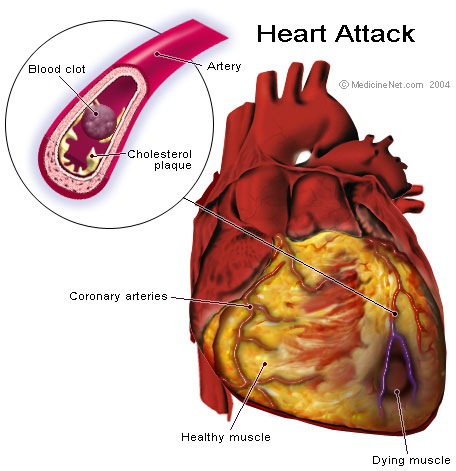[heart attack[5].jpg]
