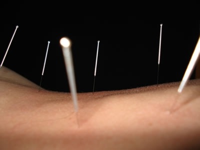 [acupuncture-needles-back[5].jpg]