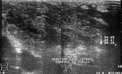 hematoma in dog. how to heal a hematoma to quad. perinephric hematoma treatment. post op laparoscopic surgery hematoma