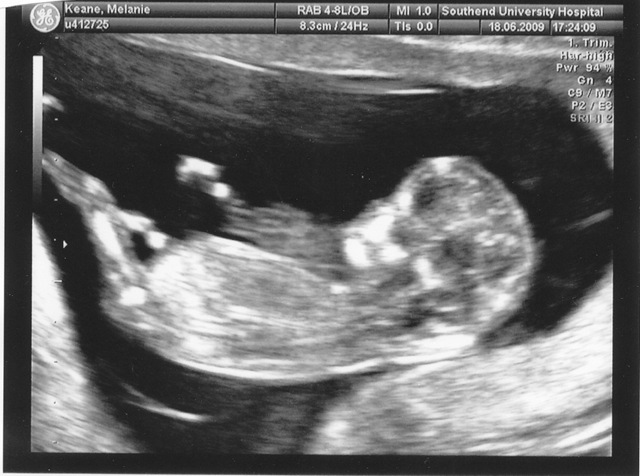 [Baby 12 weeks (c)[2].jpg]