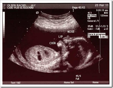 Ultrasound Pic - Side View