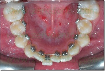 terapia linguale con attacchi terapia linguale con attacchi