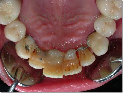 retainer impianti