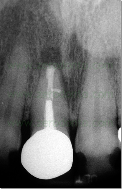 endodonzia chirurgica endodonzia chirurgica
