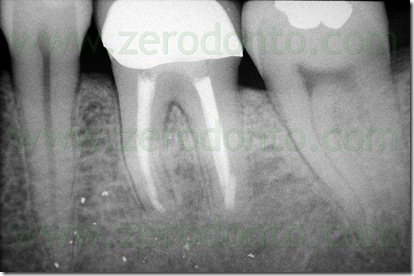 terapia endodontica terapia endodontica