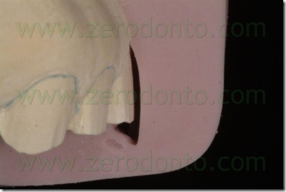 preparazione dente
