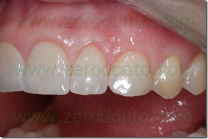 faccetta dente