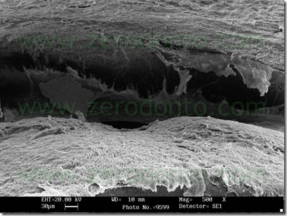 otturazione endodontica
