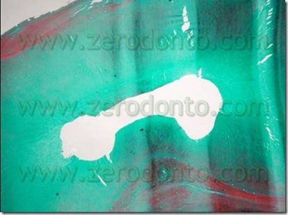 trattamento endodontico