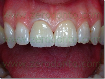 estetica corona oro-ceramica vs ceramica integrale