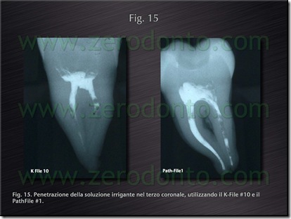 otturazione verticale otturazione verticale