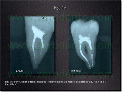 chiusura verticale endodonzia chiusura verticale endodonzia
