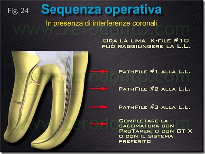 interferenza coronale endodonzia interferenza coronale endodonzia