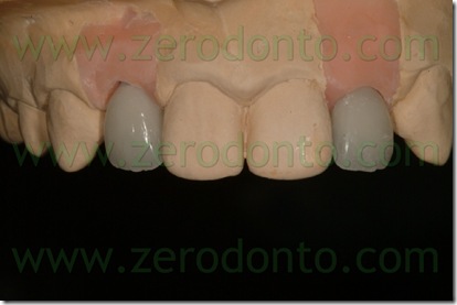 corona ceramica zirconia