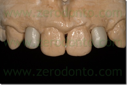 ceramica per zirconia