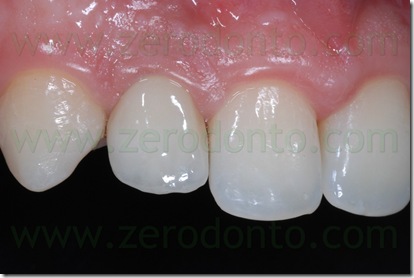 corona zirconio