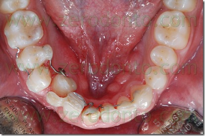 terapia ortodontica invisibile