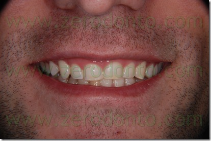 riduzione del sorriso gengivale