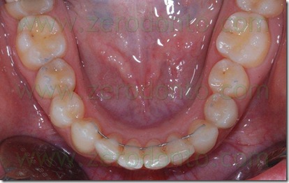 visione occlusale inferiore dopo terapia invisibile