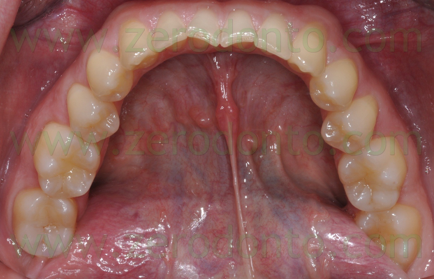 [Fig0097Rosti finrecall1.5aa[2].jpg]