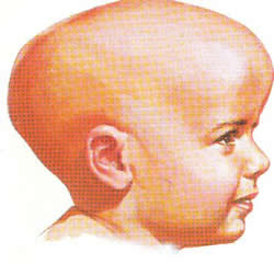 cria-hidrocef.jpg