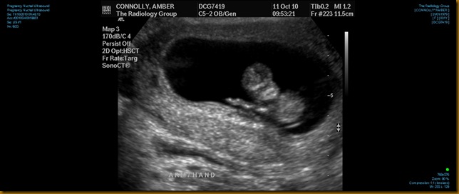 Ultrasound 0002 Waving Baby