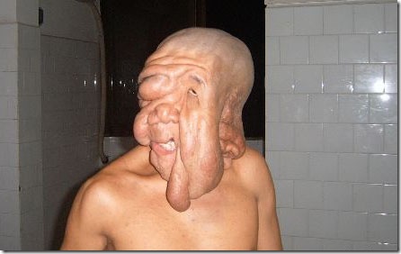 HuangChuncaisAfterSurgery-copy HuangChuncaisAfterSurgery-copy