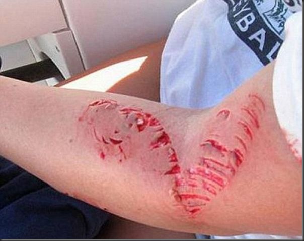 Barracuda ataca menina de 14 anos