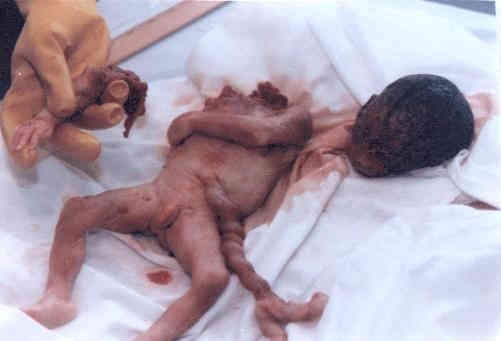 [Aborted Baby[2].jpg]