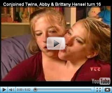 conjoined twins abby and brittany. Abigail#39;s and Brittany#39;s