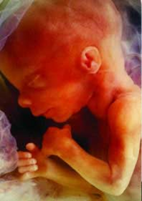 INTRAUTERINE FETAL DEATH INTRAUTERINE FETAL DEATH
