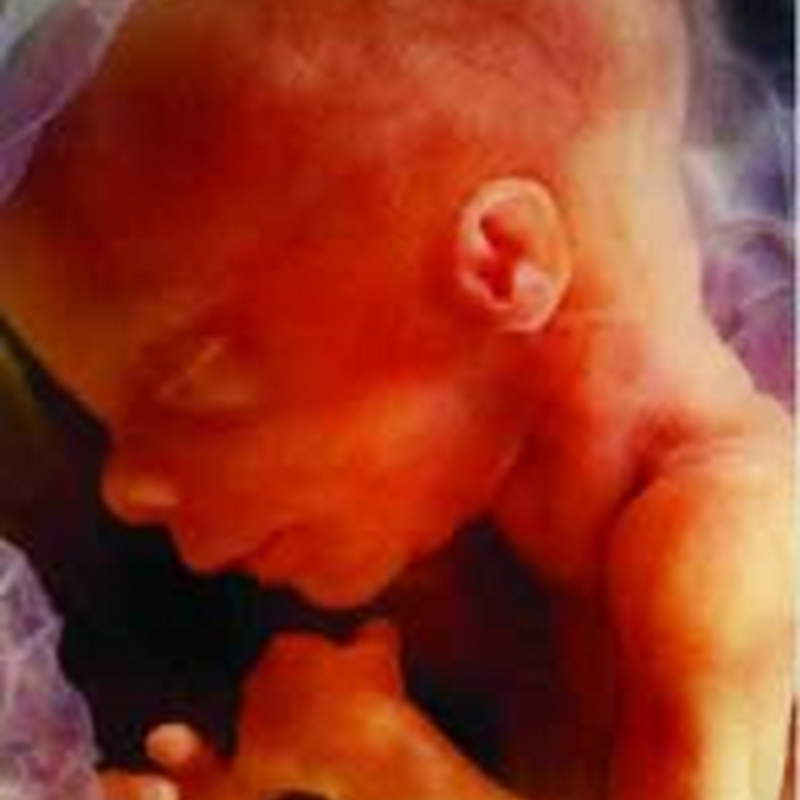 INTRAUTERINE FETAL DEATH