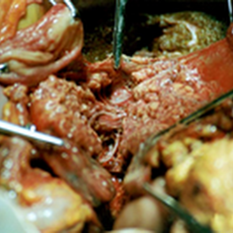 ACUTE PANCREATITIS Part 01