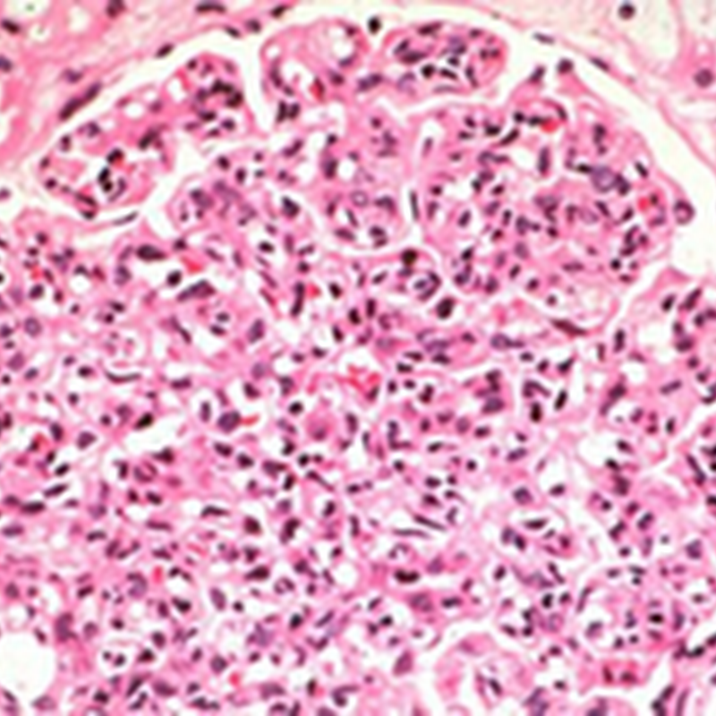 HEMOLYTIC UREMIC and NEPHRITIC/NEPHROTIC SYNDROMES