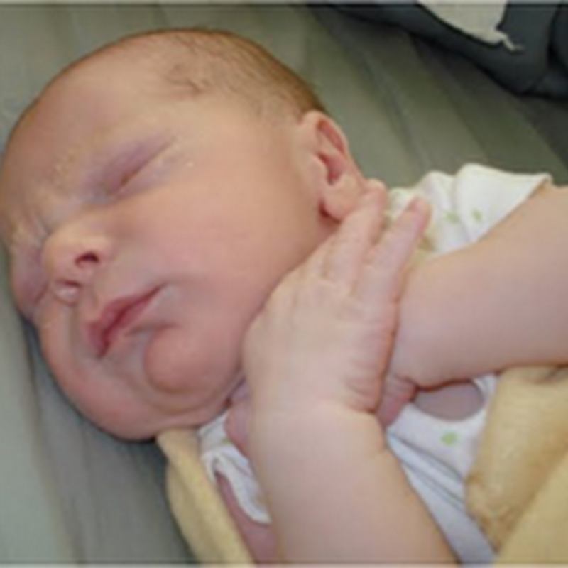 UPPER RESPIRATORY TRACT DISEASES (STRIDOR,CROUP AND EPIGLOTTITIS,FOREIGN BODY ASPIRATION)